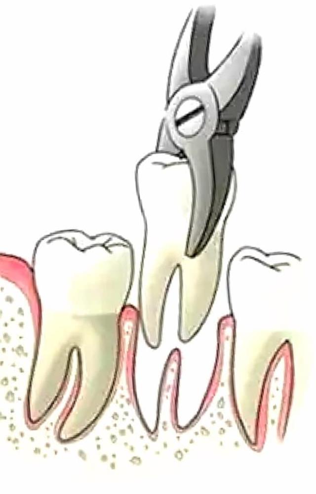 Problemi post estrazione dentale